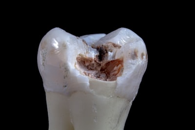 Măsea cariată — decayed tooth